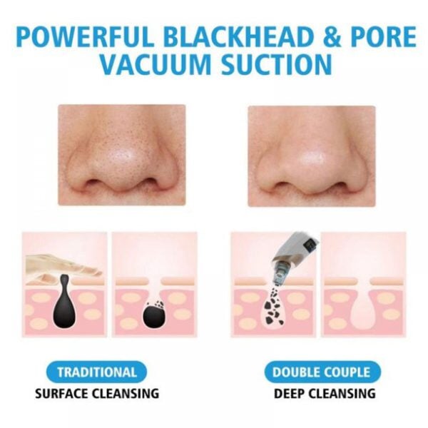 Blackhead Suction Remover Pore Vacuum | Blackhead Pore Cleaning Beauty Tool beauty gadgets ZAR INNOVATIONS 